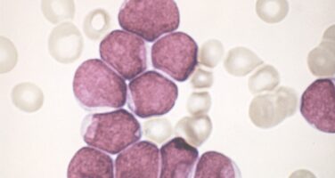 Leukaemia cells