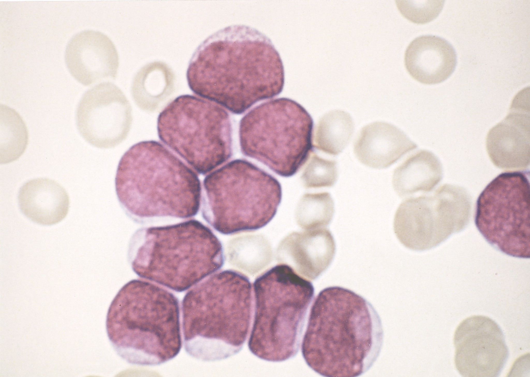 Leukaemia cells