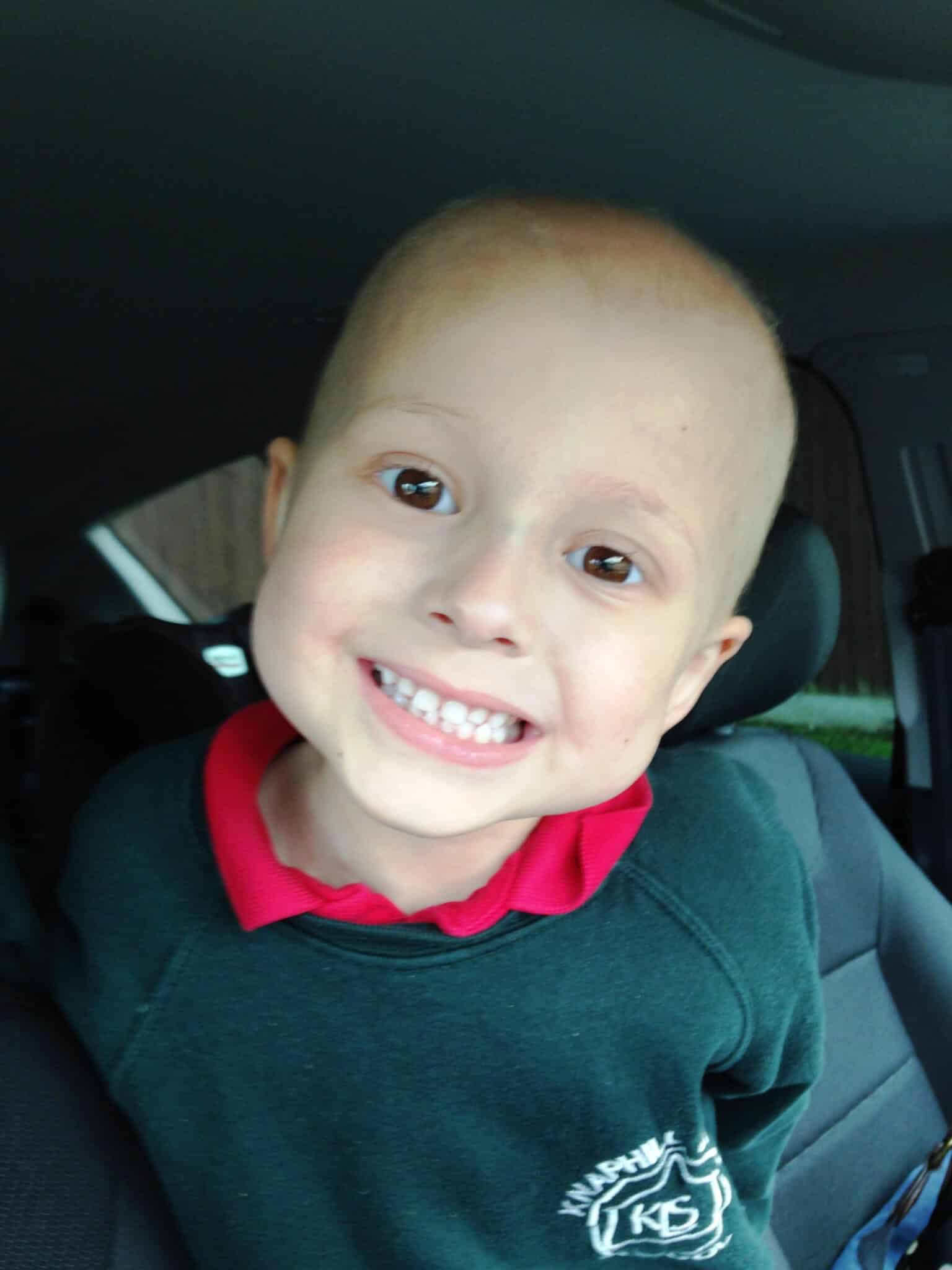 A child who started limping due to cancer