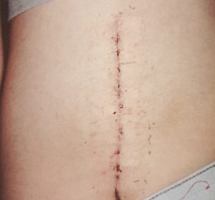 Leah's scar after surgery