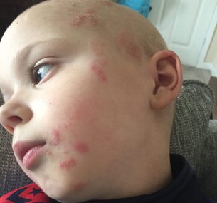 Leighton with red spots on cheek.