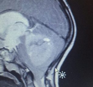 Leighton xray of his brain tumour.